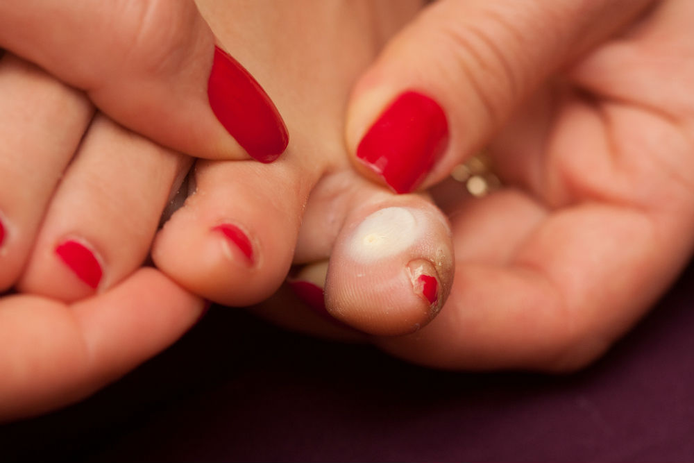 What to Do When You Get Blisters on Your Feet